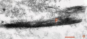 F,44y. | striations of fibrin - heart atrium, myxoma